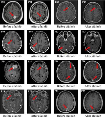 CNS efficacy of afatinib as first-line treatment in advanced non-small cell lung cancer patients with EGFR mutations
